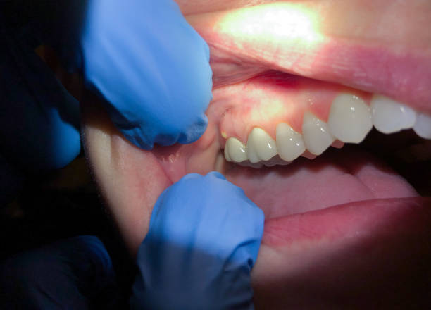 Best Knocked-Out Tooth (Avulsed Tooth) Treatment in Osceola, WI